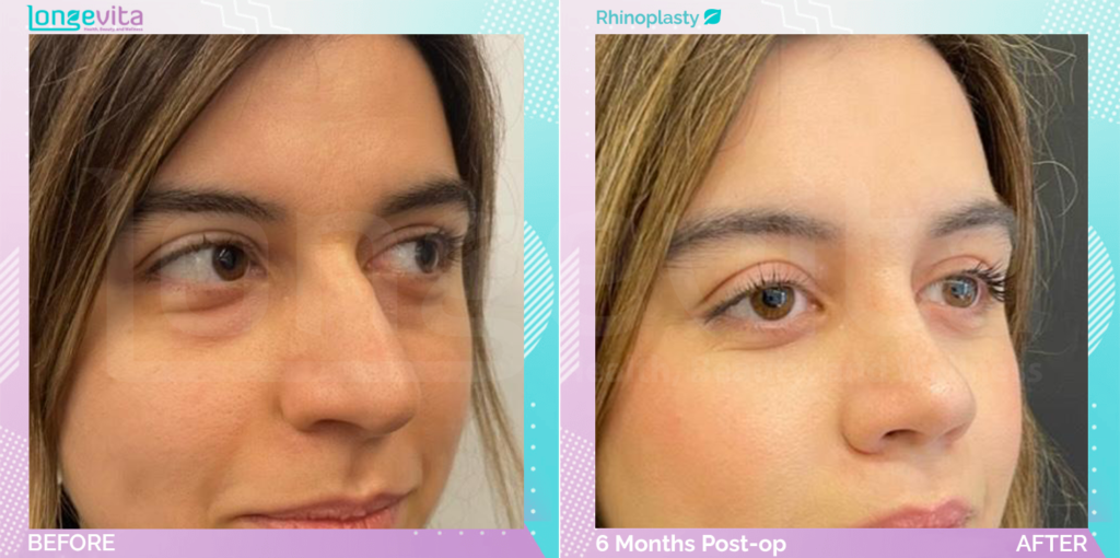 Dr Ercan Nose job before after pciture 7