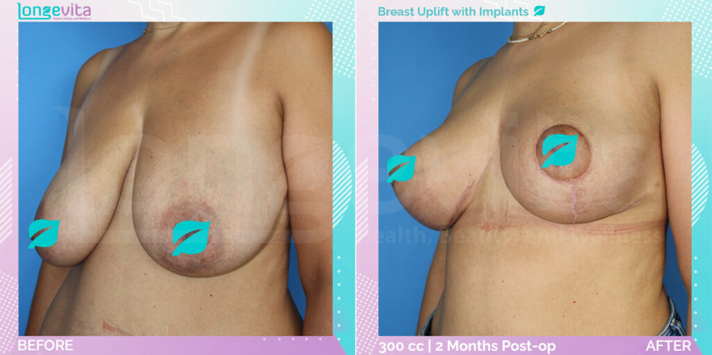 Breast uplift with implants before and after results – transformation by Dr. Sinan, picture 1.
