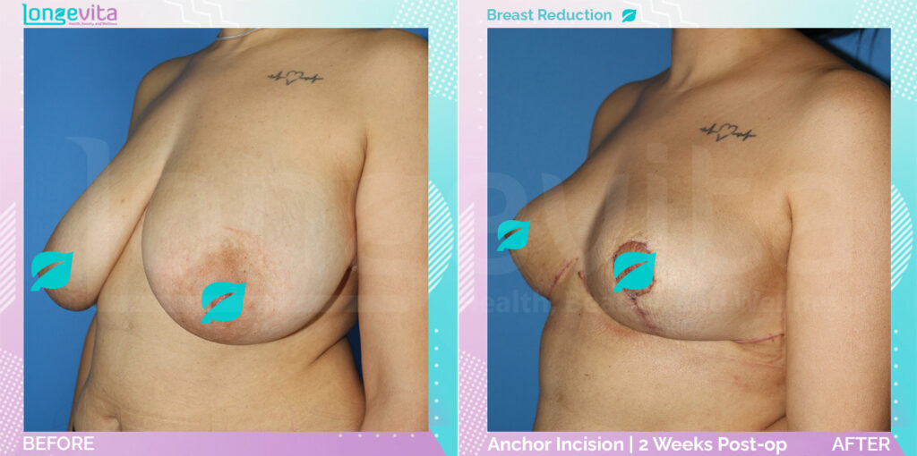 Breast reduction before and after results – transformation by Dr. Sinan, picture 2.