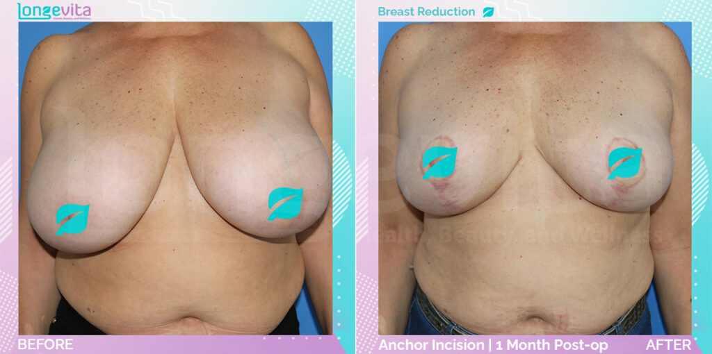 Dr Sinan Breast patient Breast Surgery Patient 3