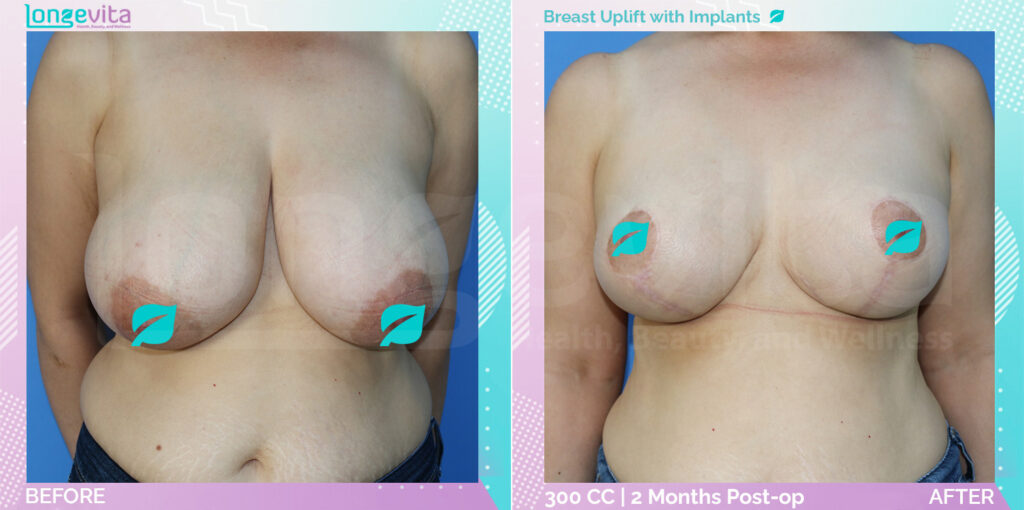 Dr Sinan Breast patient Breast Surgery before after 8