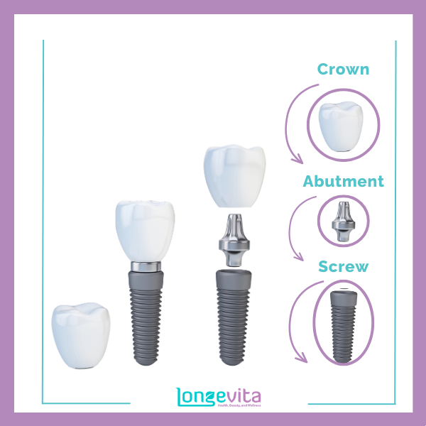 Dental Implant Structure