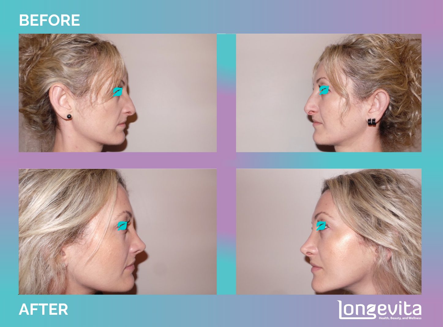 Rhinoplasty before and after, Face