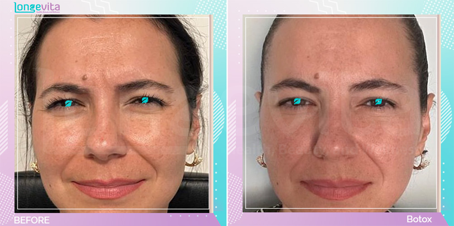 Botox Injections before and after, Face