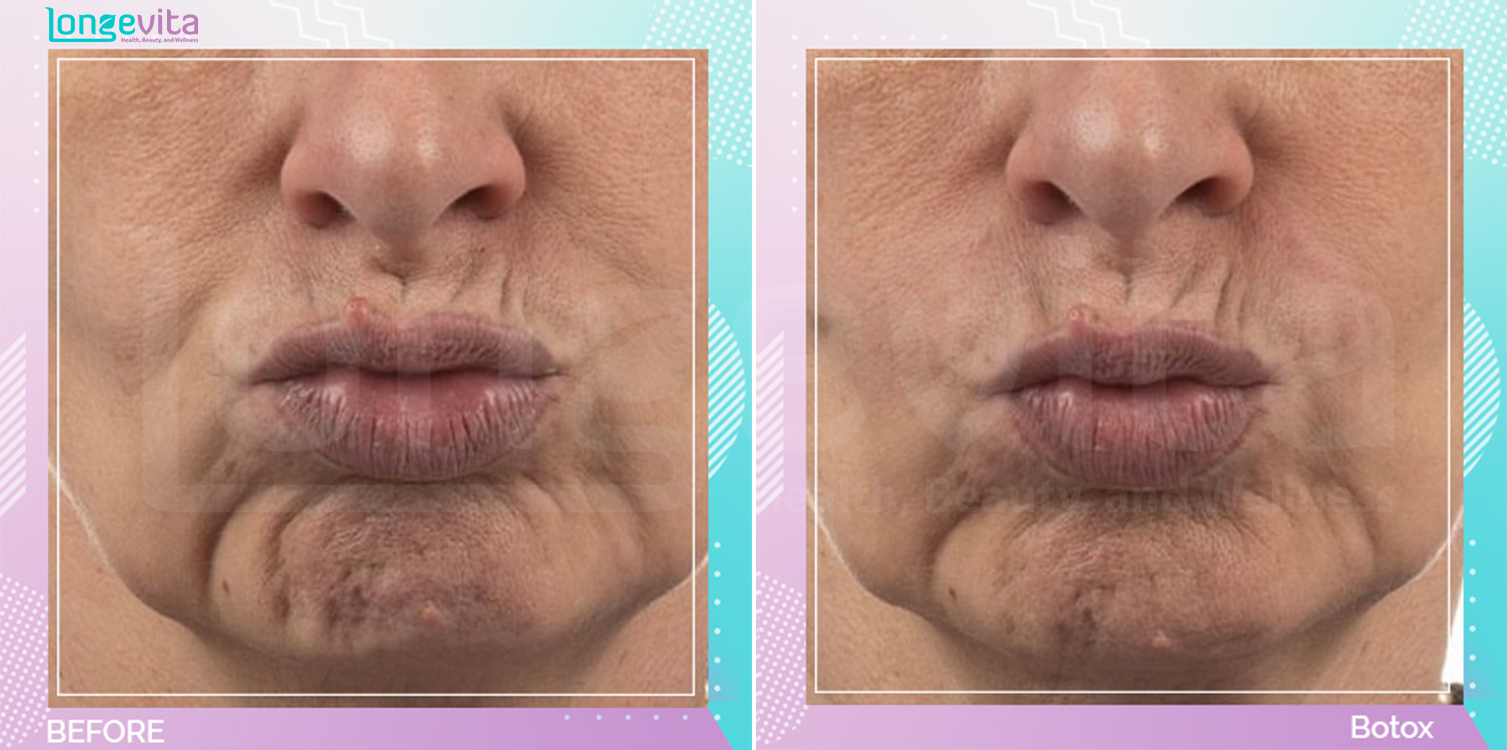 Botox Injections before and after, Face