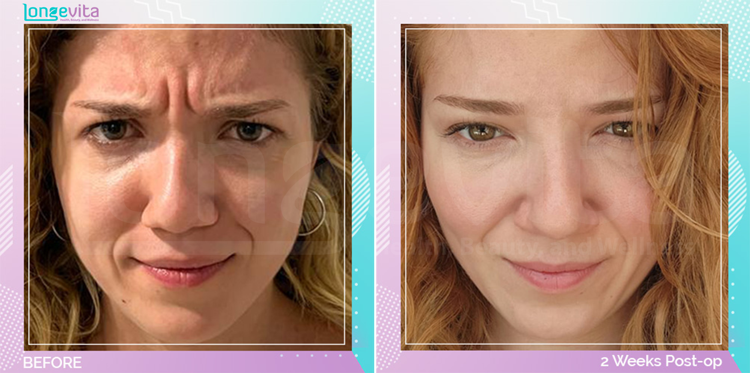 Botox Injections before and after, Face