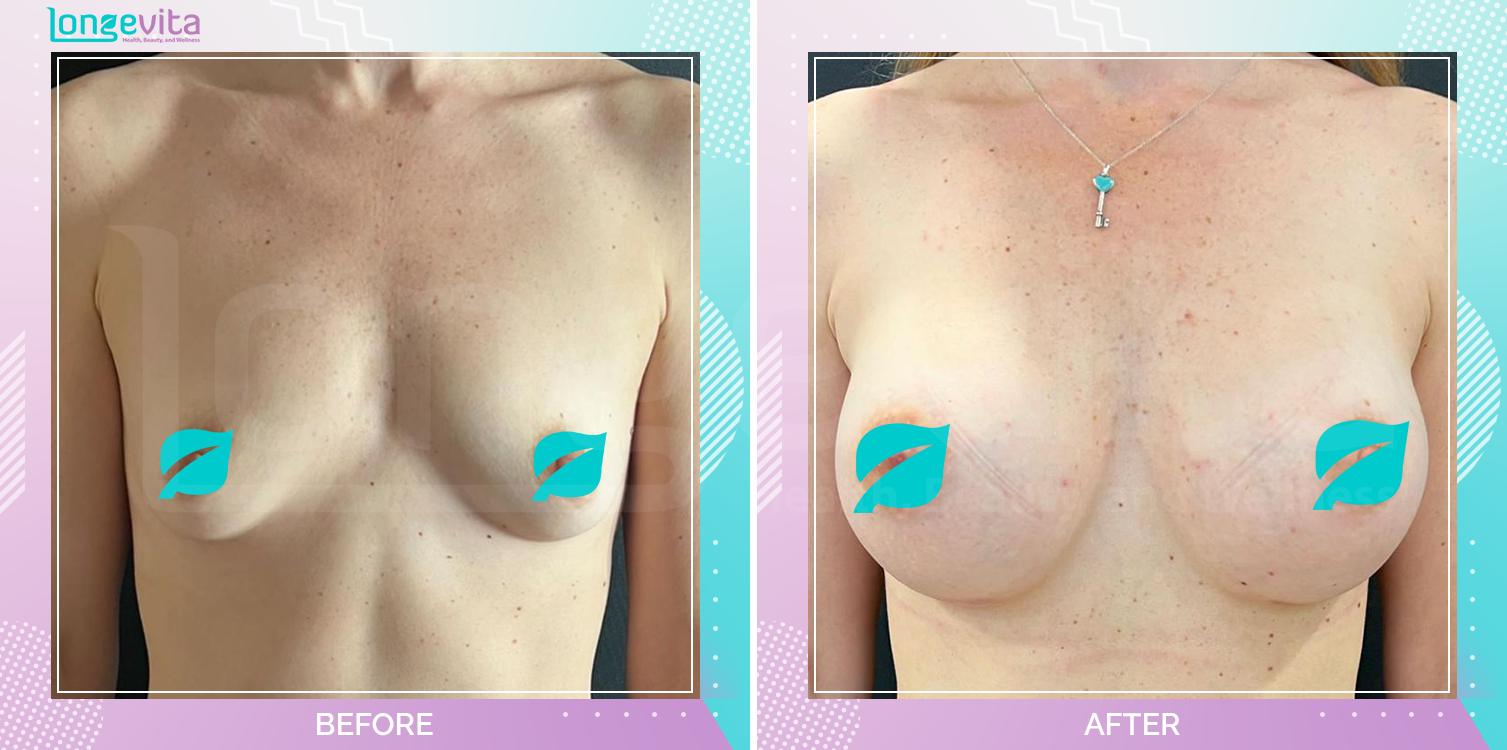 Breast Enlargement before and after, Breast