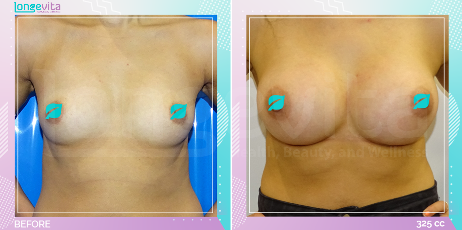 Breast Enlargement before and after, Breast