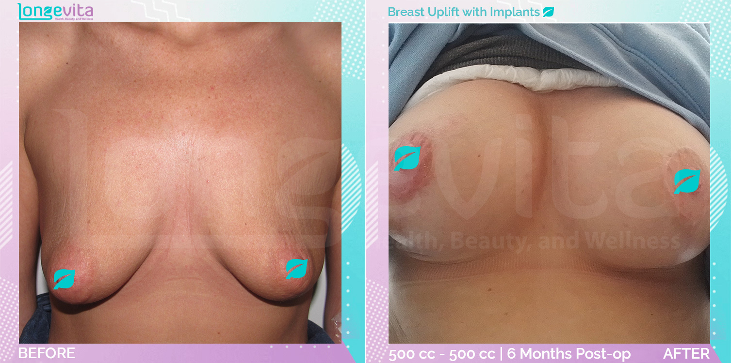 Breast Enlargement and Breast Lift before and after, Breast, 30s female patient