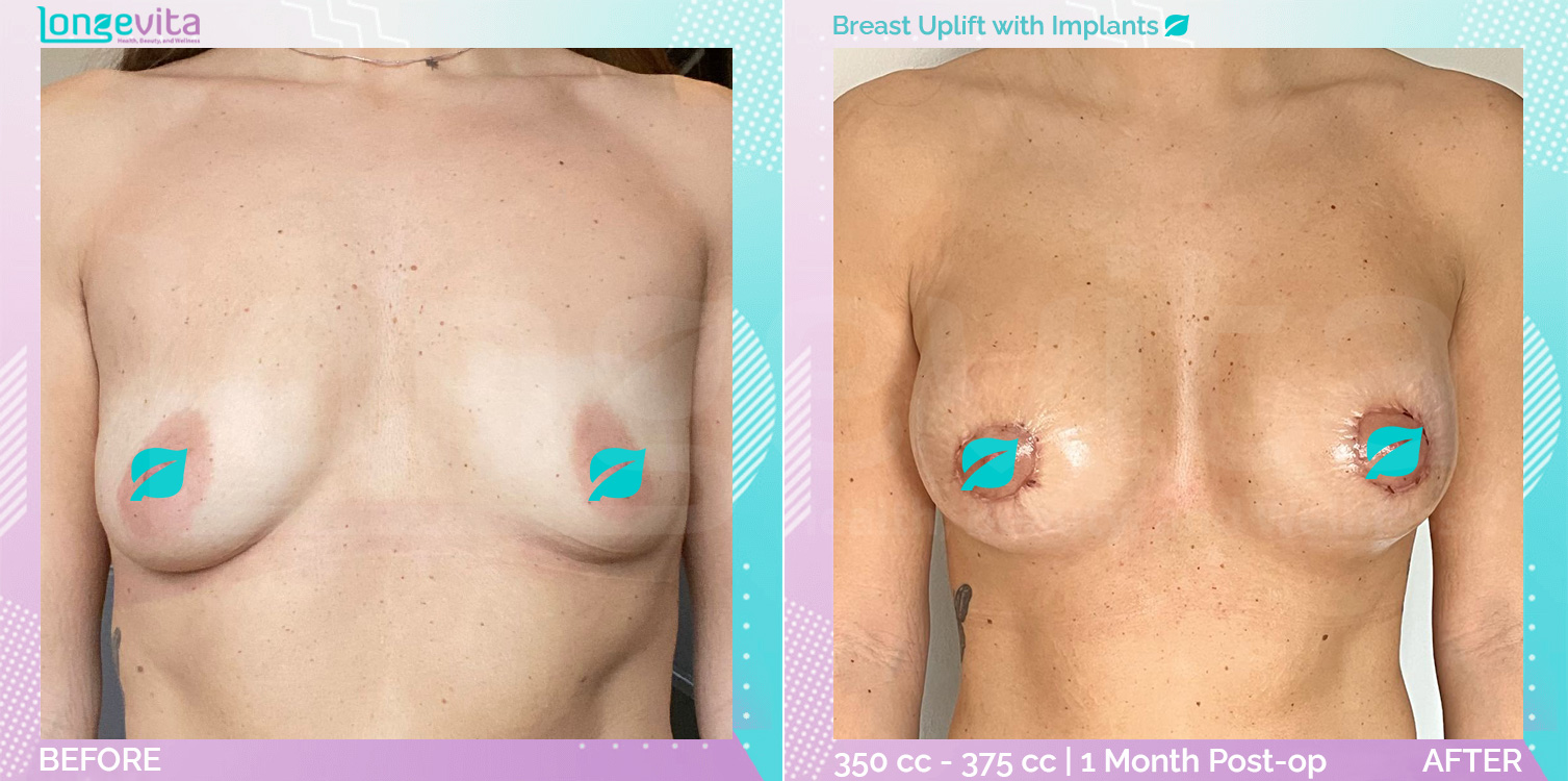 Breast Enlargement and Breast Lift before and after, Breast, 30s female patient
