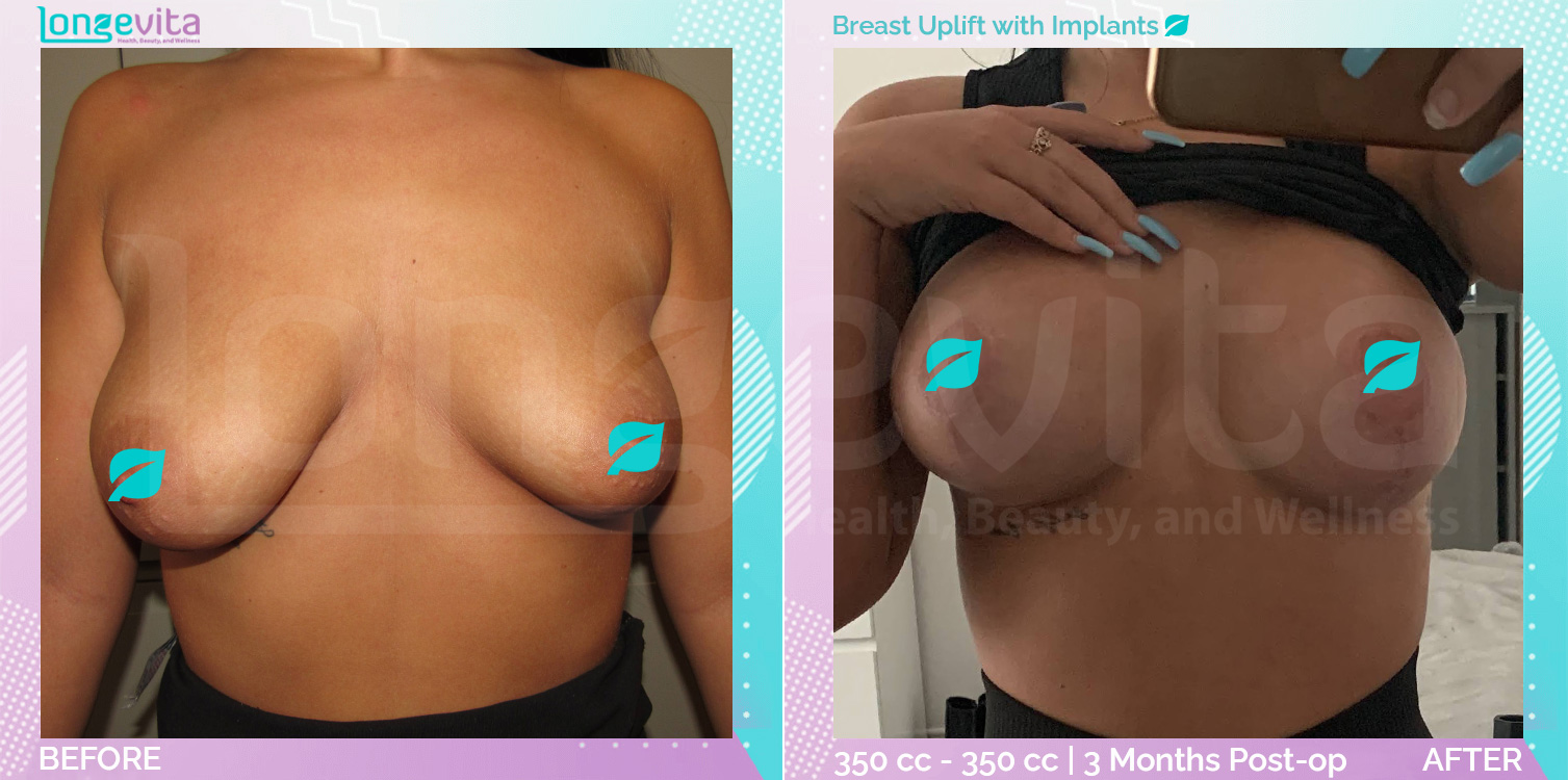 Breast Enlargement and Breast Lift before and after, Breast, 20s female patient