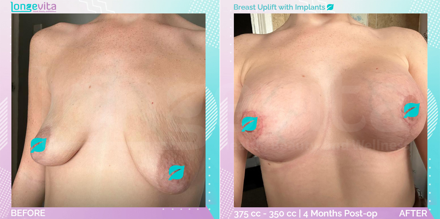 Breast Enlargement and Breast Lift before and after, Breast, 10s female patient