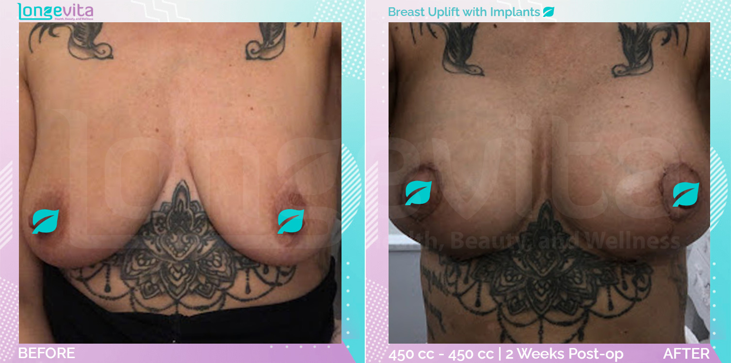 Breast Enlargement and Breast Lift before and after, Breast, 30s female patient
