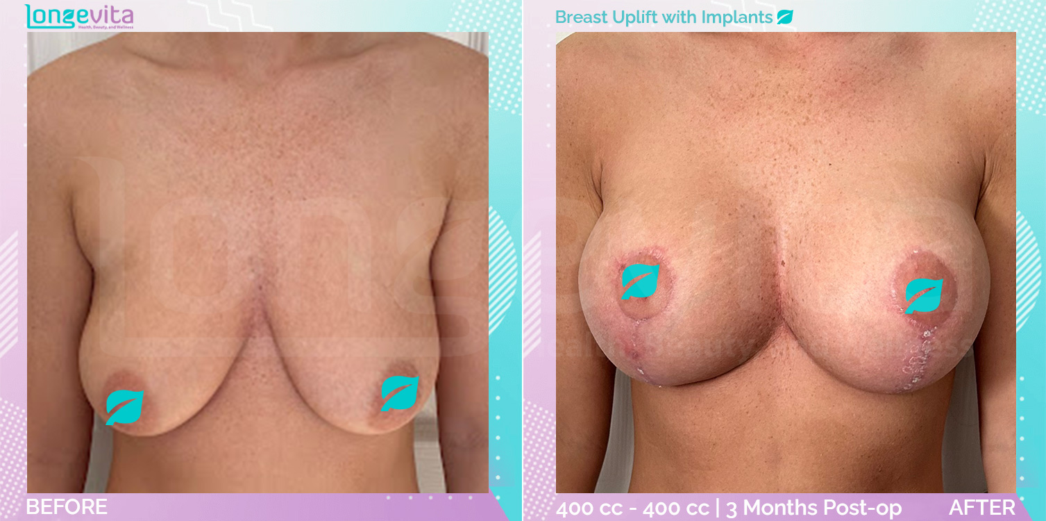 Breast Enlargement and Breast Lift before and after, Breast, 20s female patient