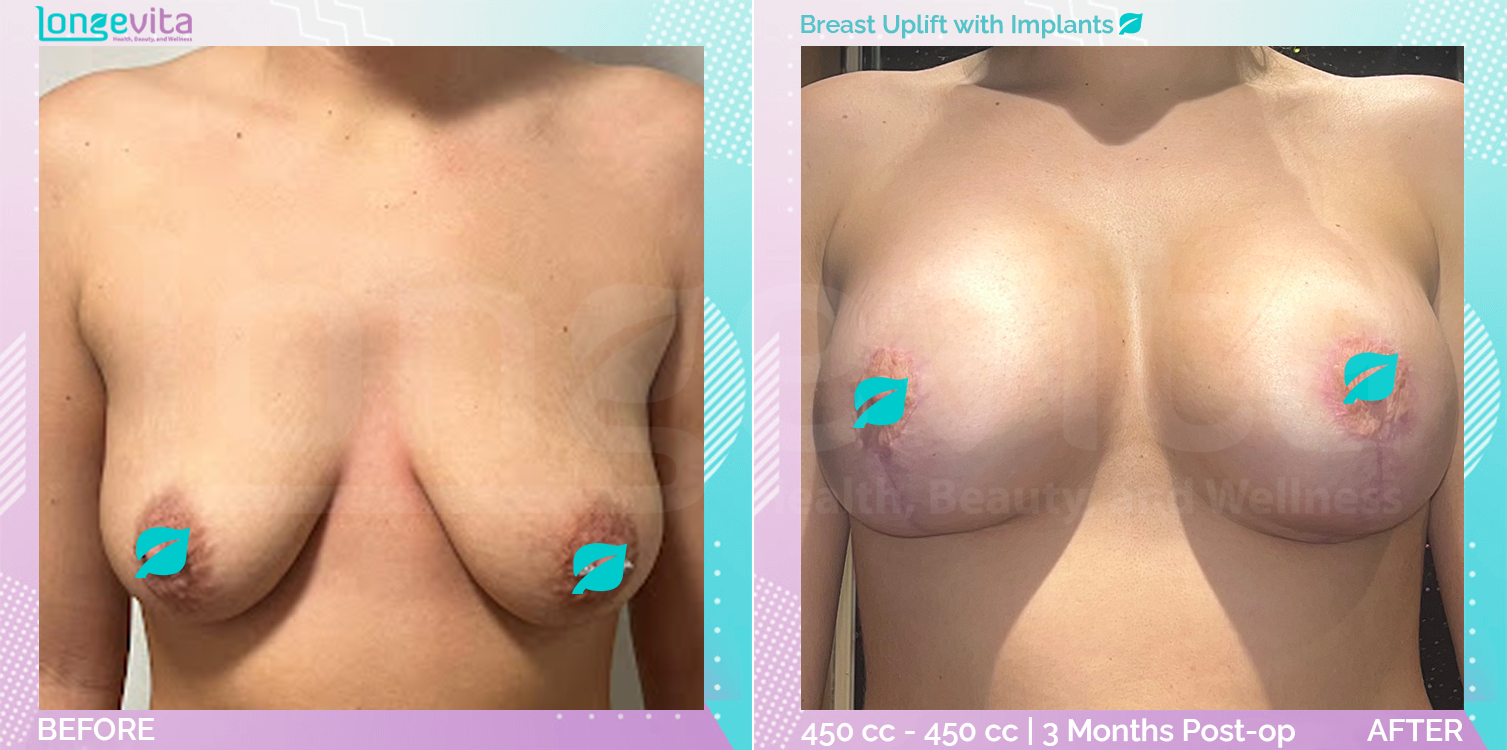 Breast Enlargement and Breast Lift before and after, Breast, 20s female patient