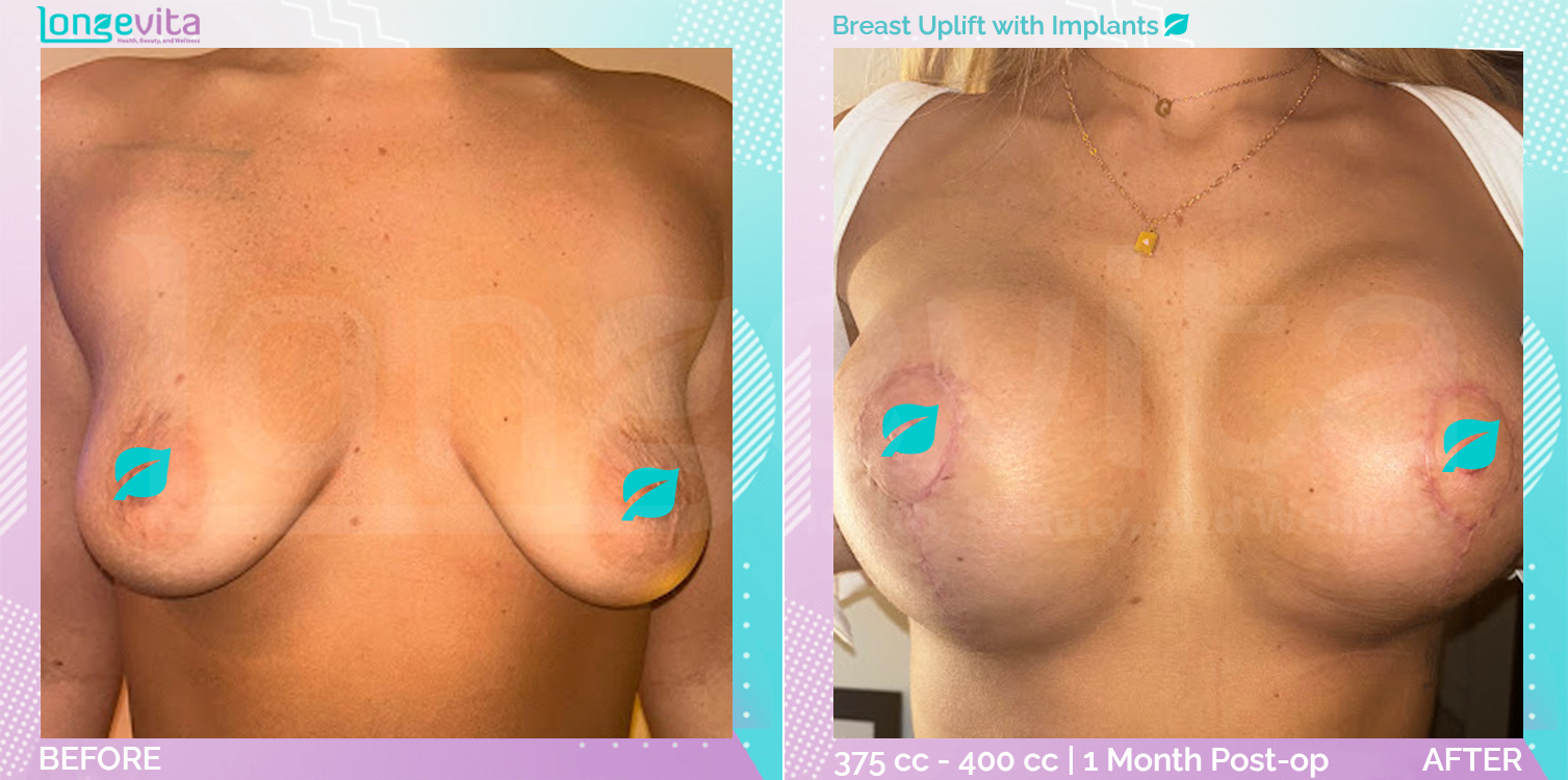 Breast Enlargement and Breast Lift before and after, Breast, 20s female patient