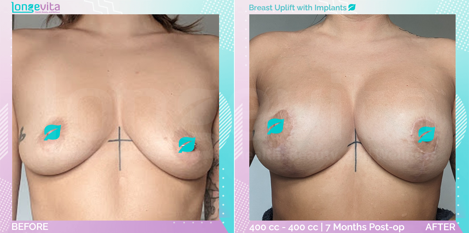 Breast Enlargement and Breast Lift before and after, Breast, 30s female patient
