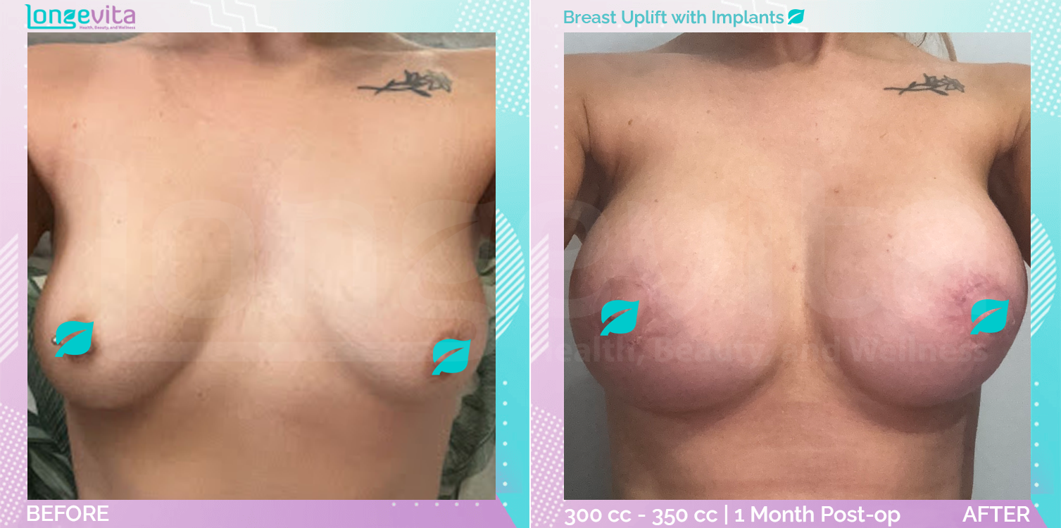 Breast Enlargement and Breast Lift before and after, Breast, 20s female patient
