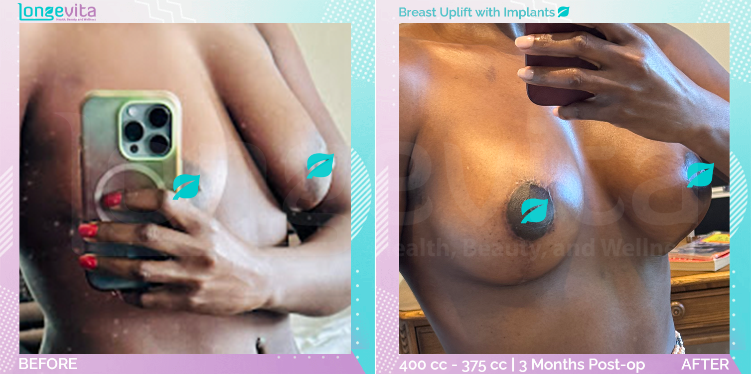 Breast Enlargement and Breast Lift before and after, Breast, 30s female patient