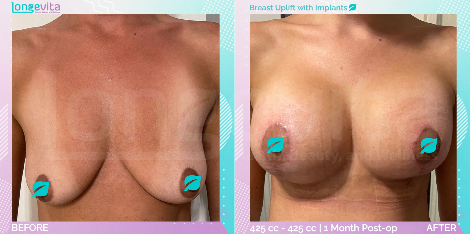 Breast Enlargement and Breast Lift before and after, Breast, 30s female patient