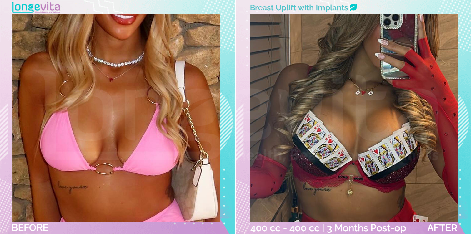 Breast Enlargement and Breast Lift before and after, Breast, 20s female patient