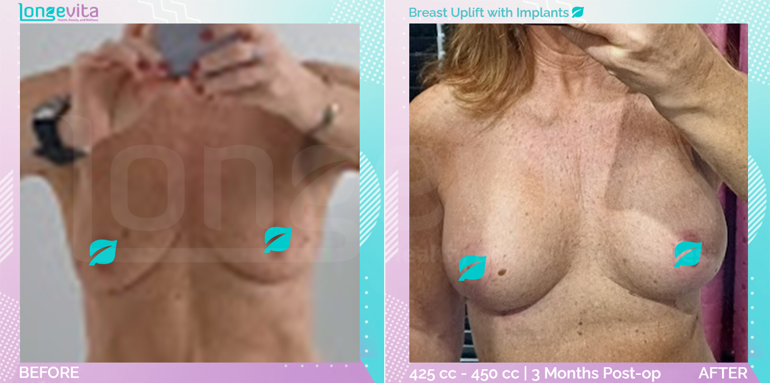 Breast Enlargement and Breast Lift before and after, Breast, 50s female patient
