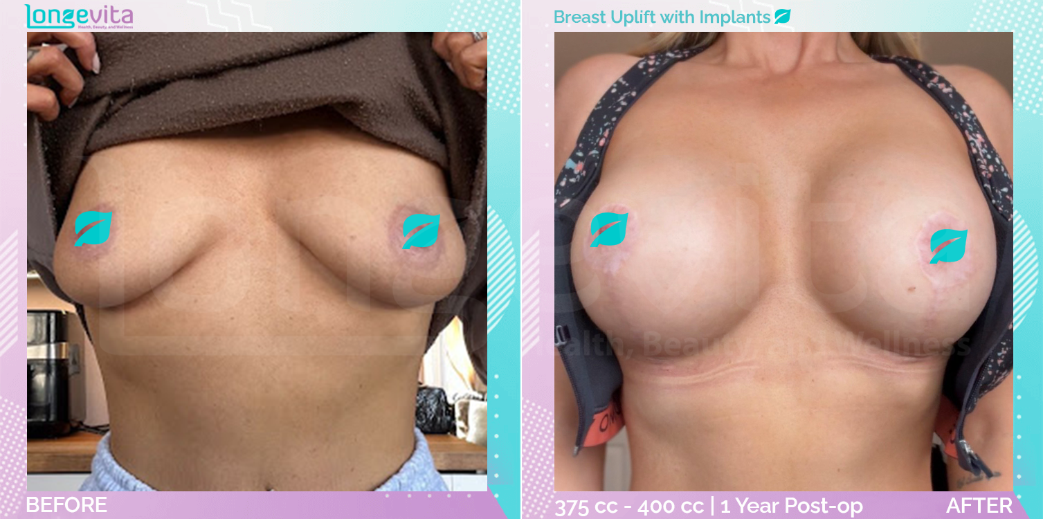 Breast Enlargement and Breast Lift before and after, Breast, 30s female patient