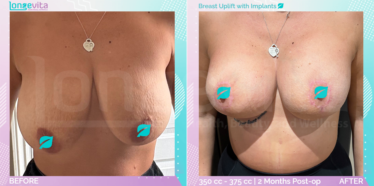 Breast Enlargement and Breast Lift before and after, Breast, 30s female patient