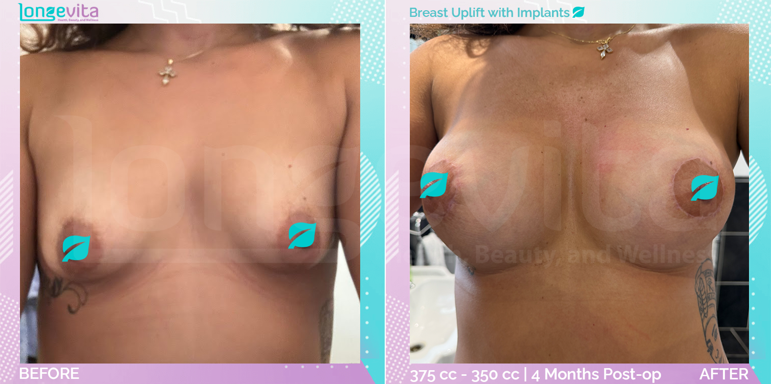 Breast Enlargement and Breast Lift before and after, Breast, 20s female patient