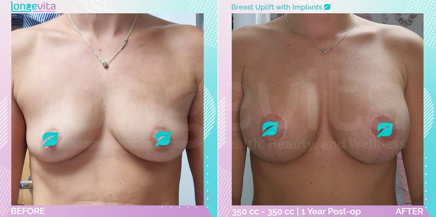 Breast Enlargement and Breast Lift before and after, Breast, 30s female patient