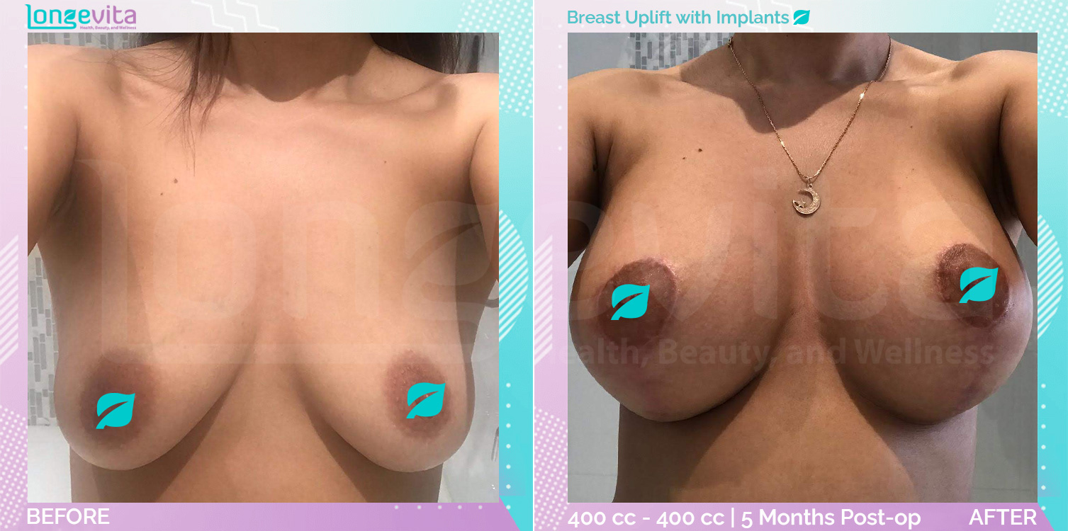 Breast Enlargement and Breast Lift before and after, Breast, 30s female patient