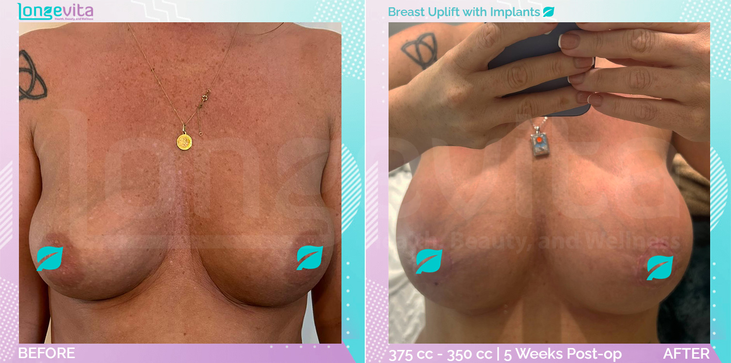 Breast Enlargement and Breast Lift before and after, Breast, 30s female patient
