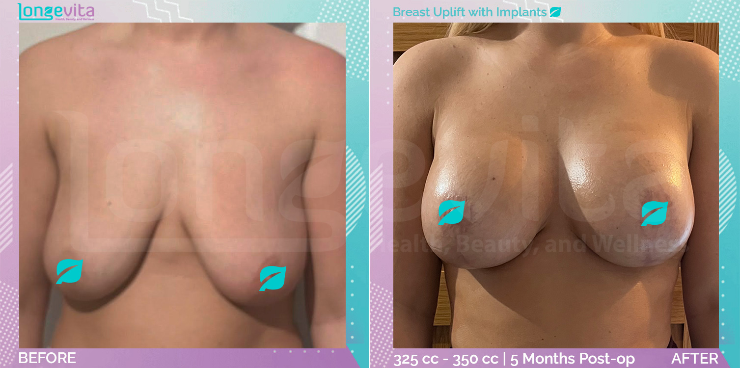 Breast Enlargement and Breast Lift before and after, Breast, 30s female patient