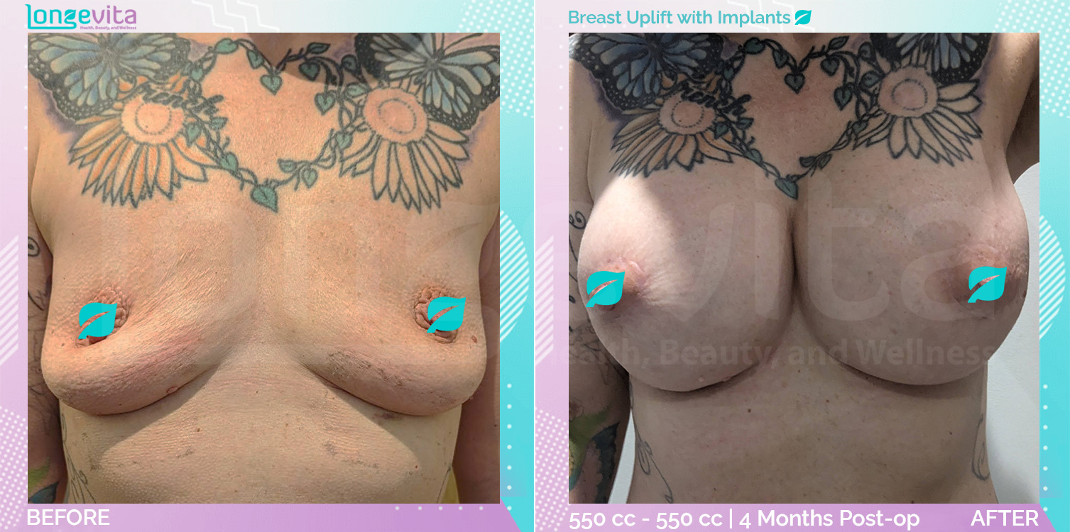 Breast Enlargement and Breast Lift before and after, Breast, 40s female patient