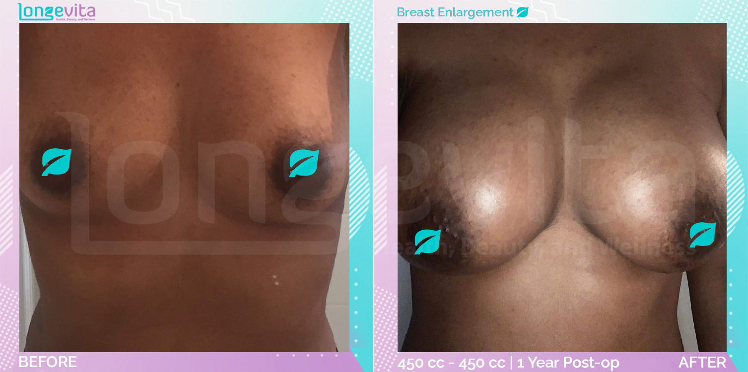 Breast Enlargement before and after, Breast