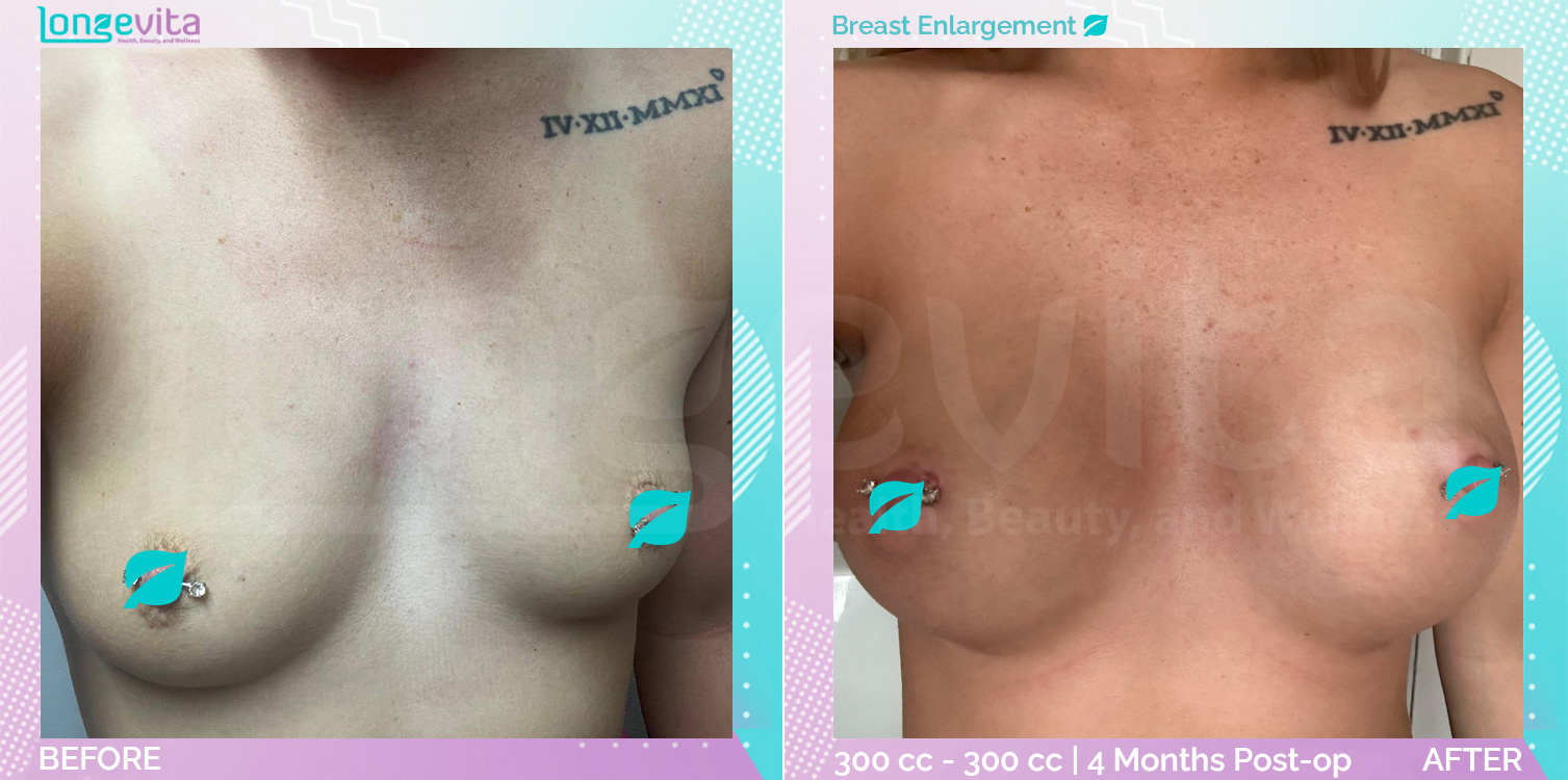 Breast Enlargement before and after, Breast, 20s female patient