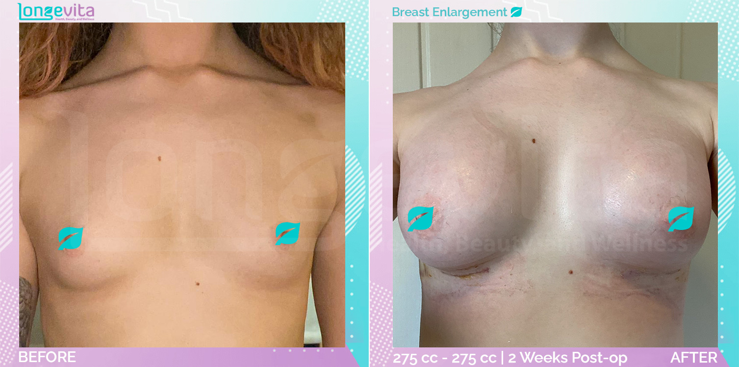 Breast Enlargement before and after, Breast, 20s female patient
