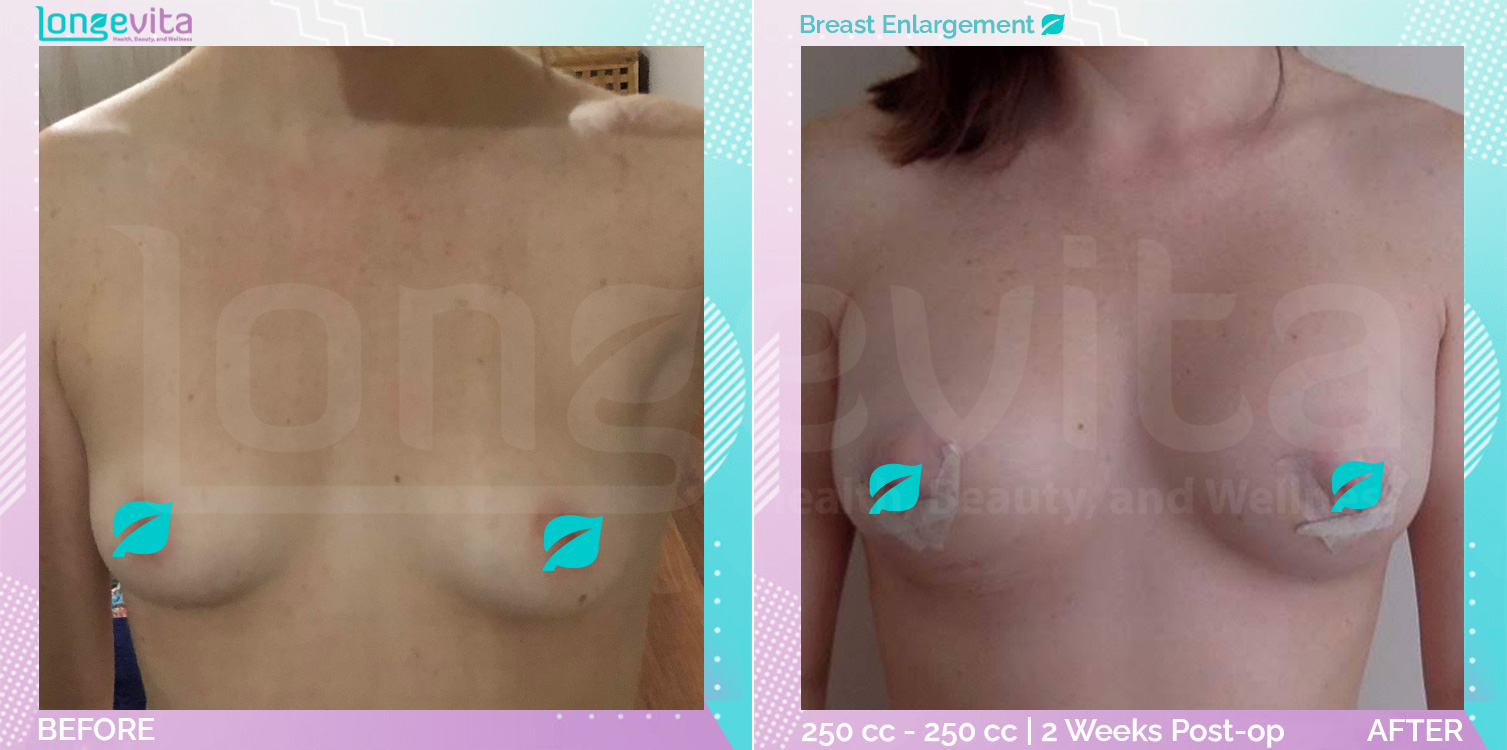 Breast Enlargement before and after, Breast, 30s female patient