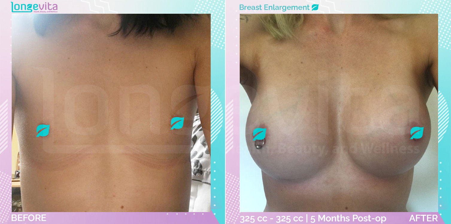 Breast Enlargement before and after, Breast