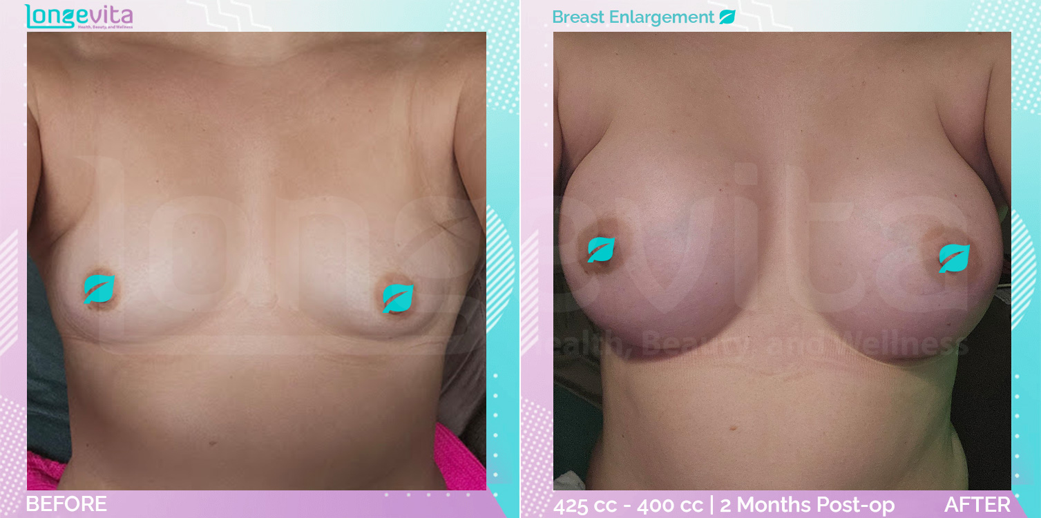 Breast Enlargement before and after, Breast, 30s female patient