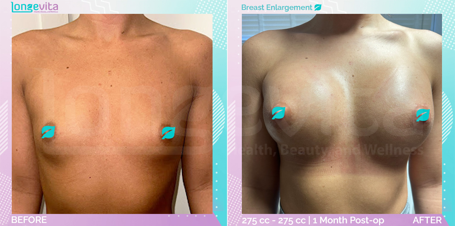 Breast Enlargement before and after, Breast, 20s female patient