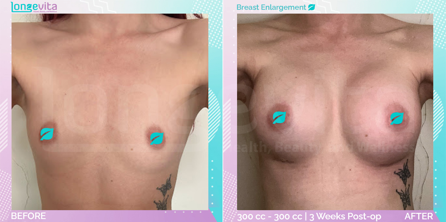 Breast Enlargement before and after, Breast, 20s female patient