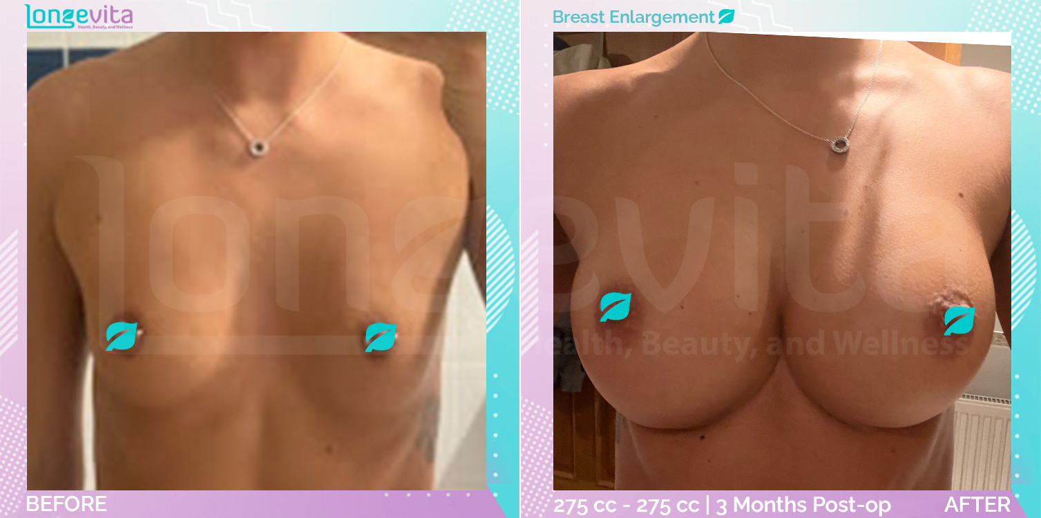 Breast Enlargement before and after, Breast, 20s female patient