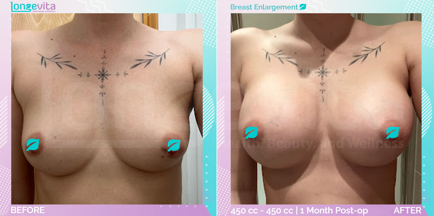 Breast Enlargement before and after, Breast, 20s female patient