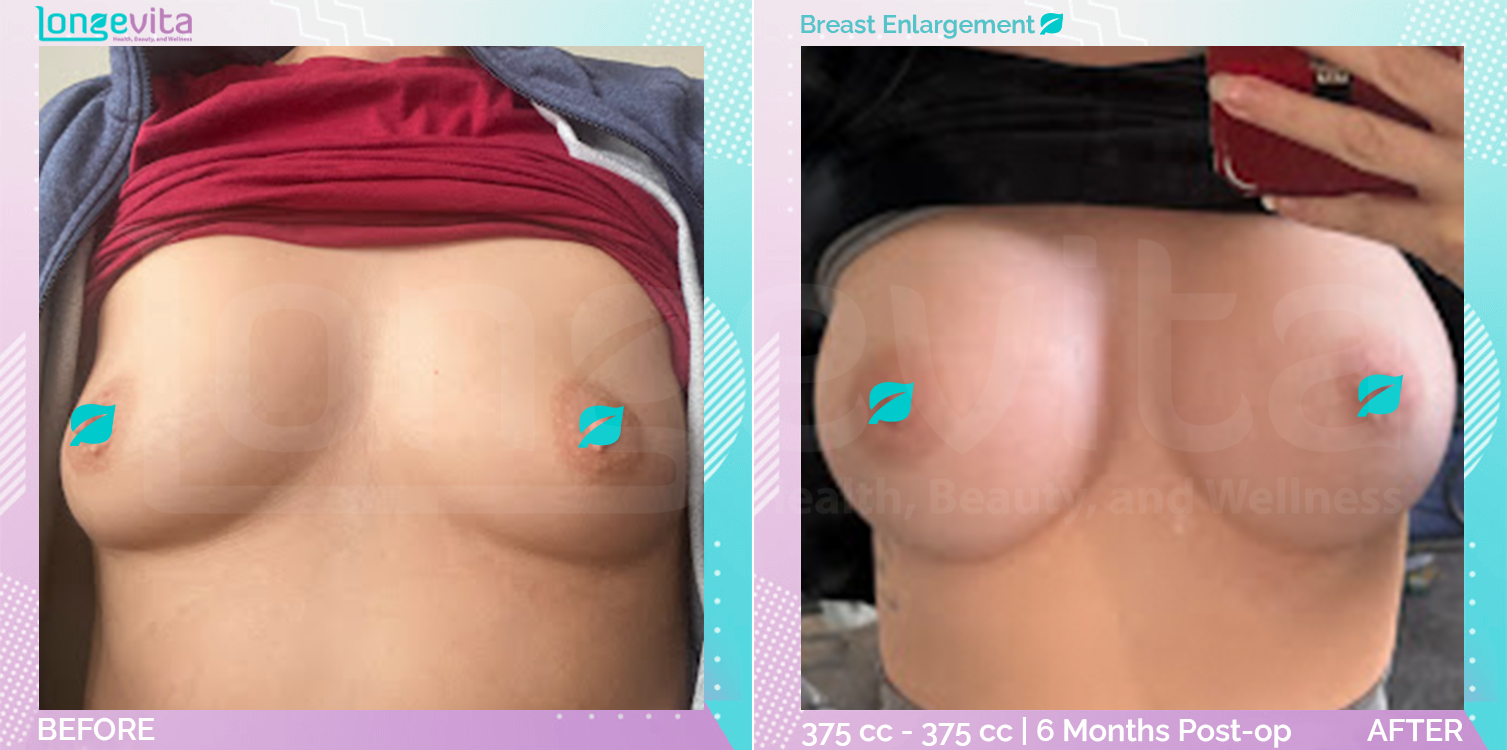 Breast Enlargement before and after, Breast, 30s female patient