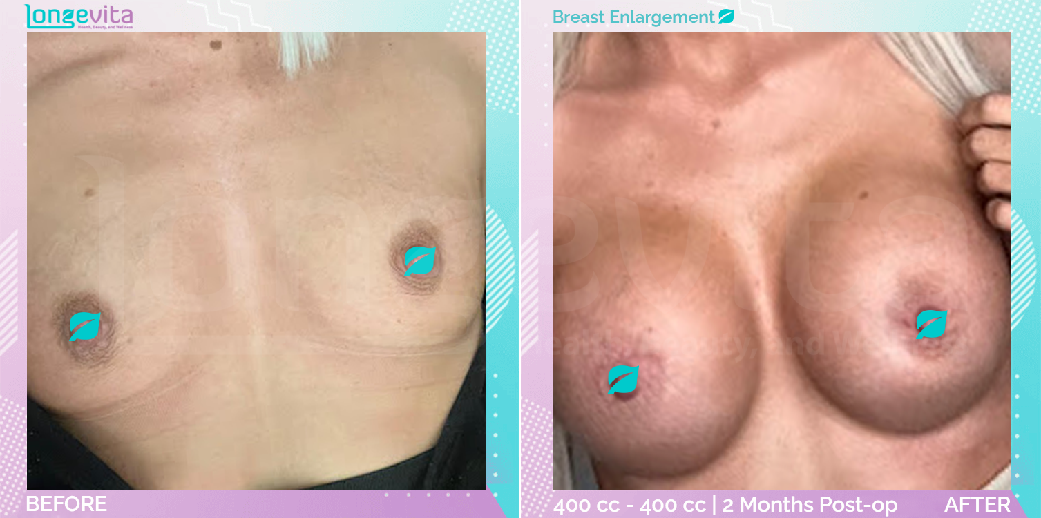 Breast Enlargement before and after, Breast, 20s female patient