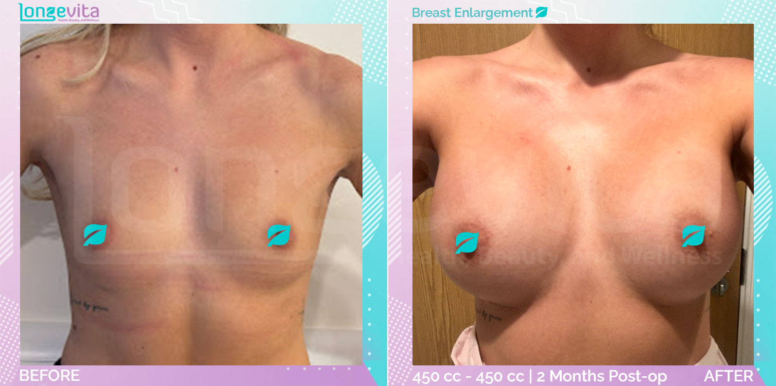 Breast Enlargement before and after, Breast, 20s female patient