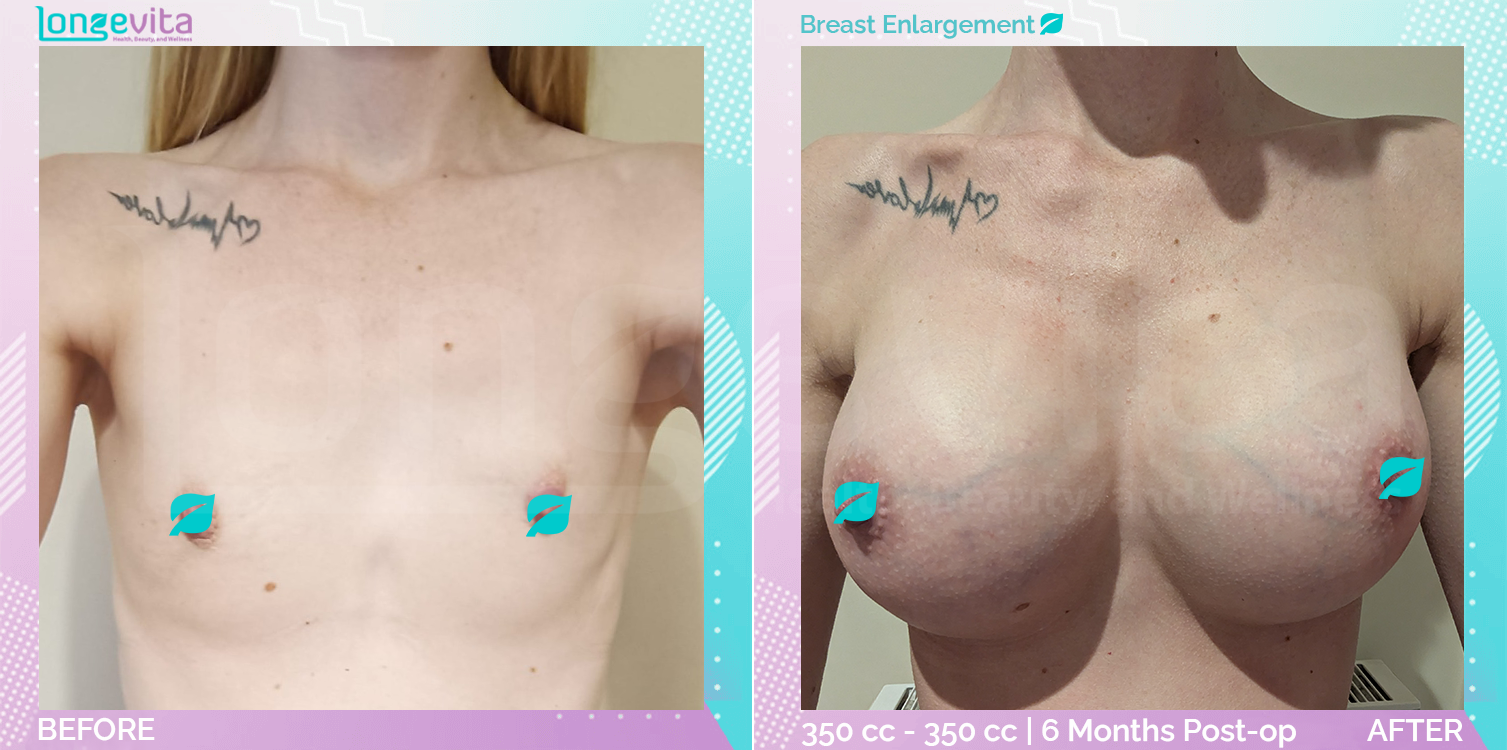 Breast Enlargement before and after, Breast, 20s female patient