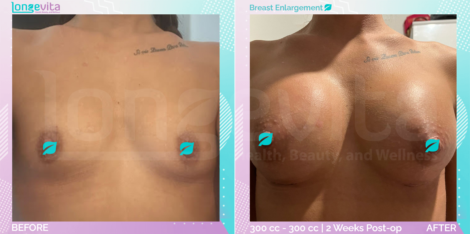 Breast Enlargement before and after, Breast, 30s female patient