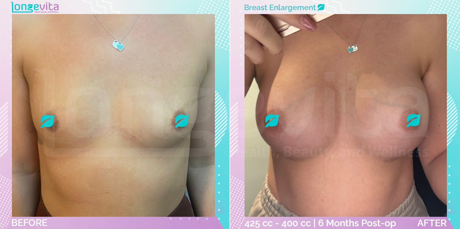 Breast Enlargement before and after, Breast, 30s female patient